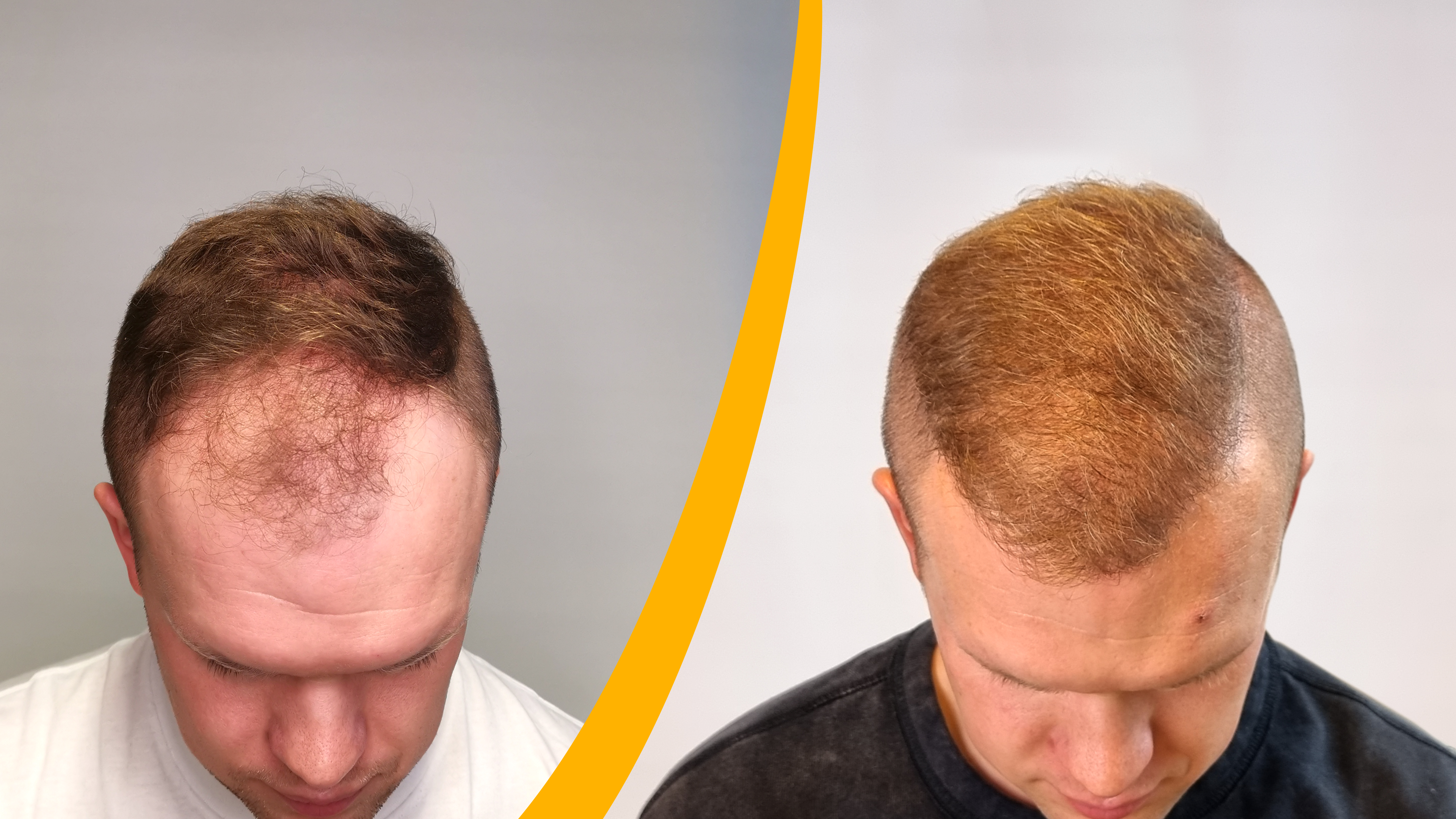 Före-Efter hårtransplantation resultat