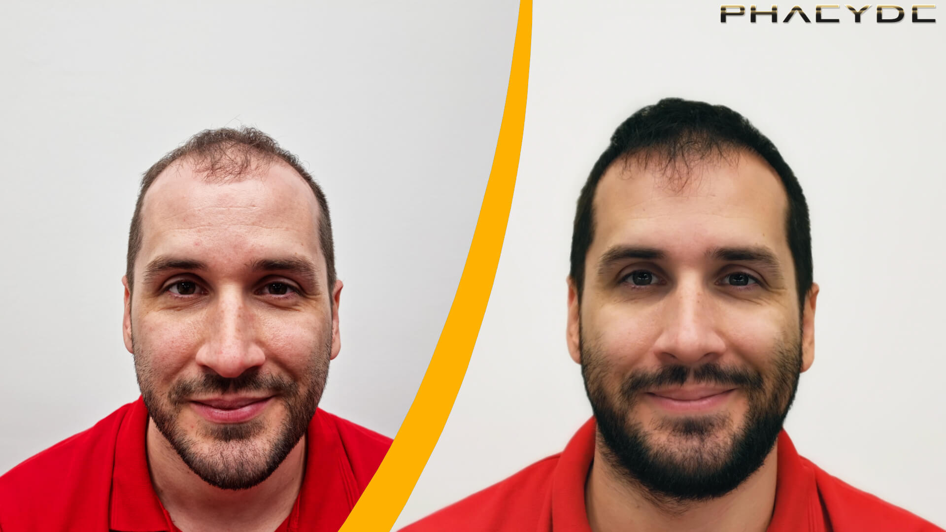 Resultat före och efter hårtransplantation