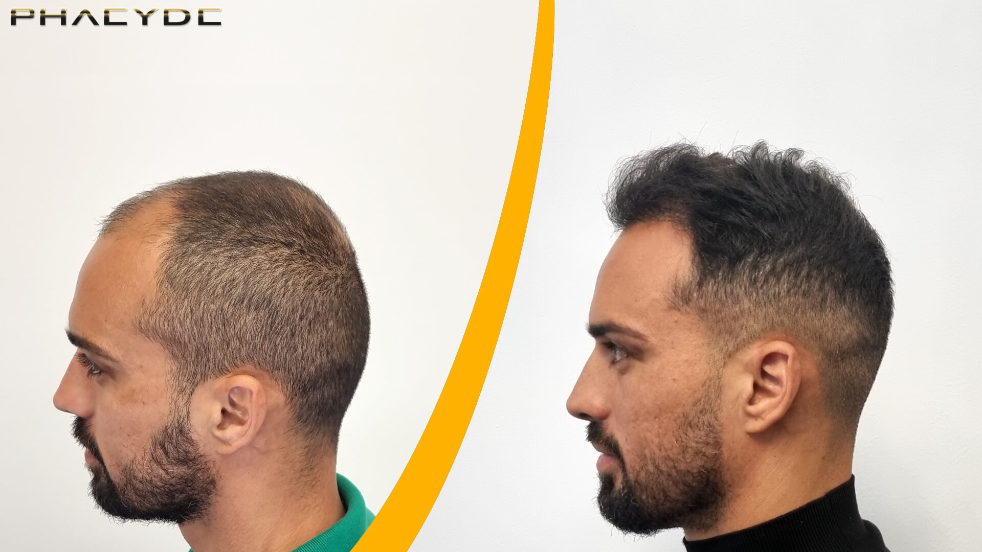Håransplantat - Före & Efter-resultat