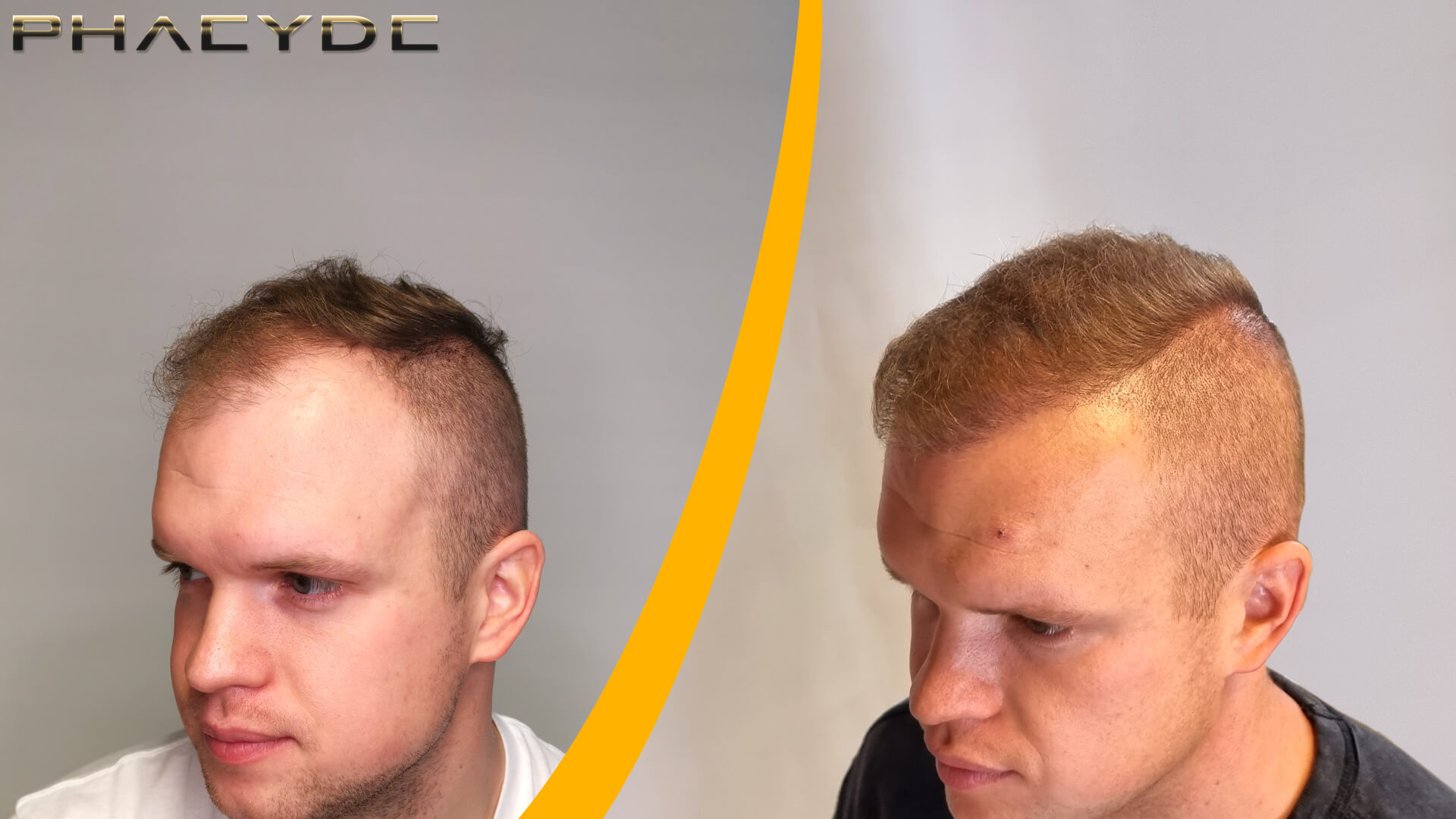 Patrik: Före-efter hårtransplantation