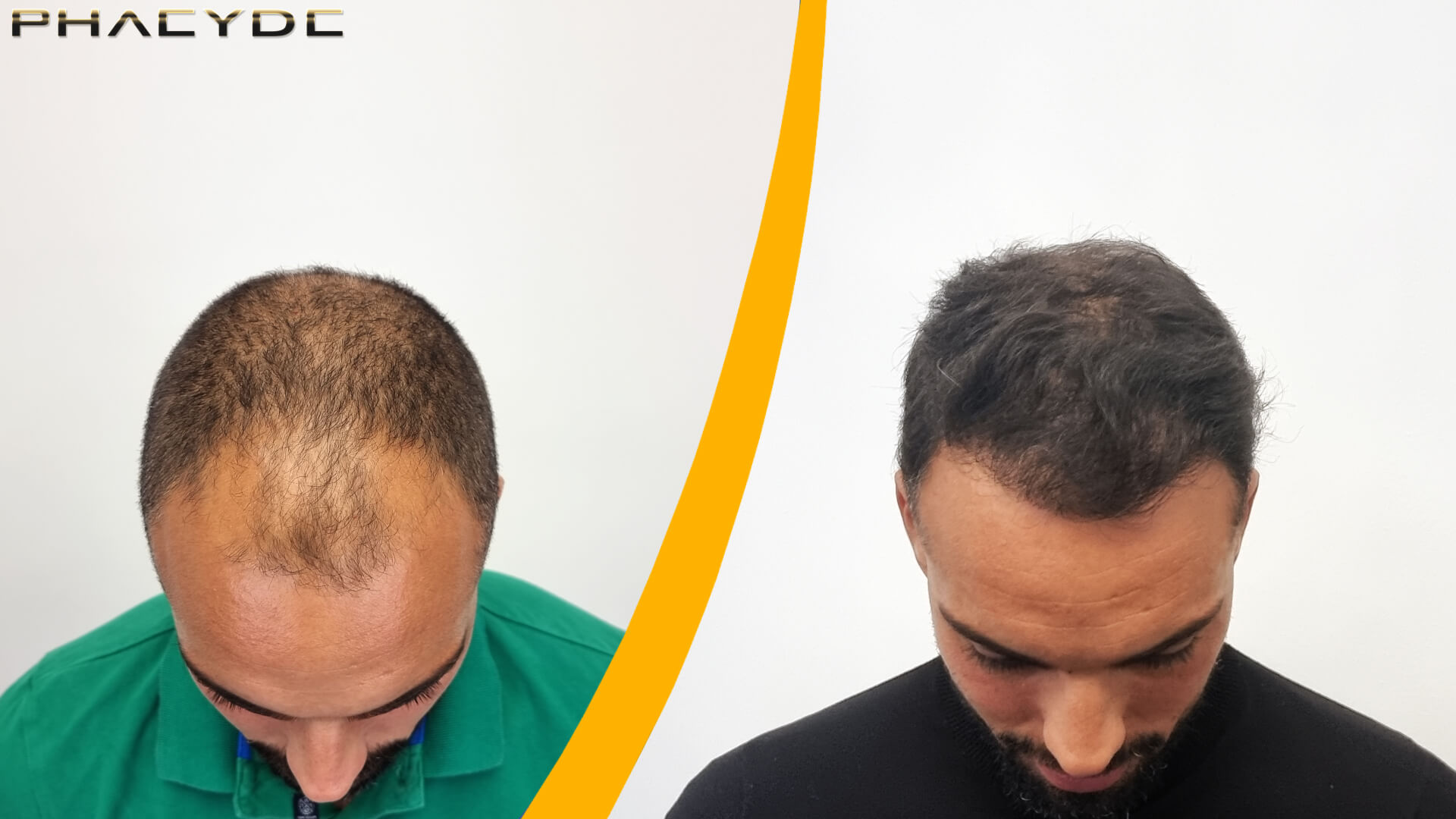 Resultat av Hårtransplantation Före och Efter