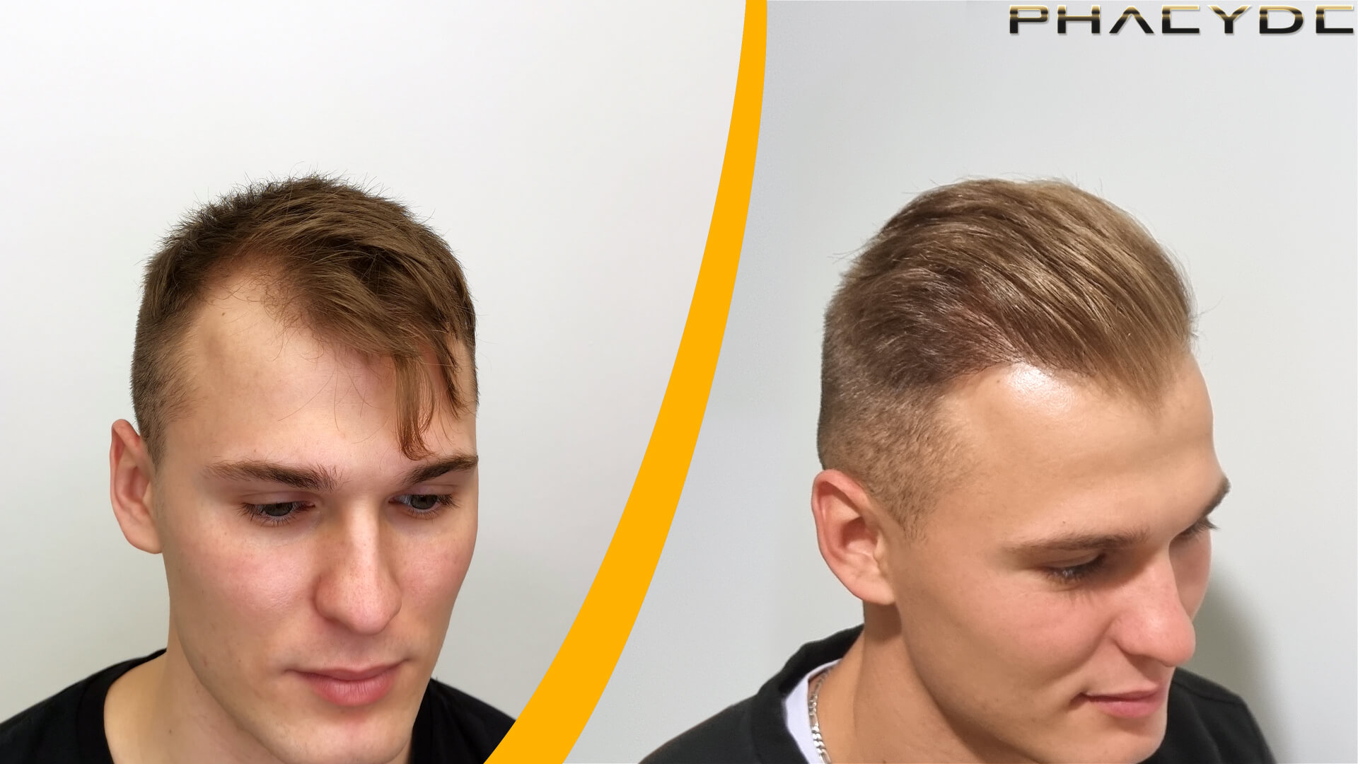 Resultat före och efter hårtransplantation