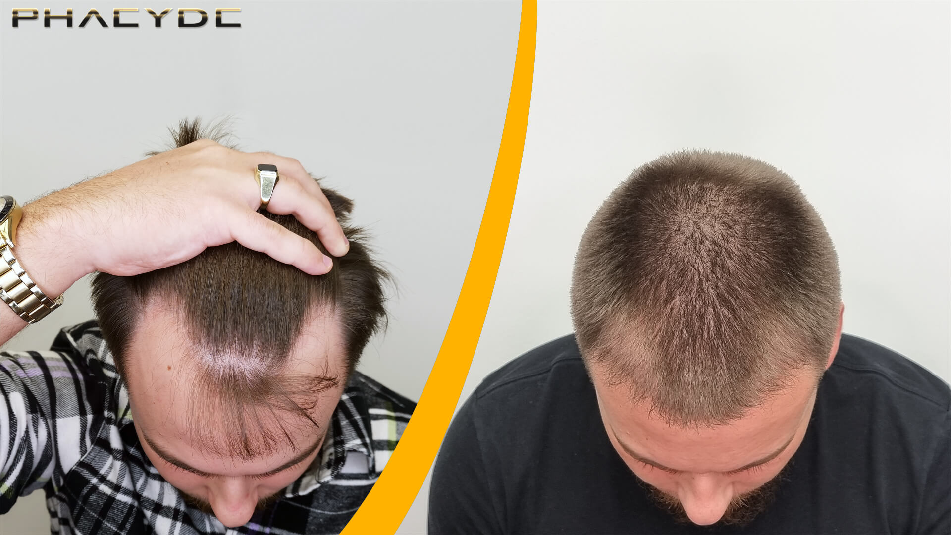 Resultat före och efter hårtransplantation