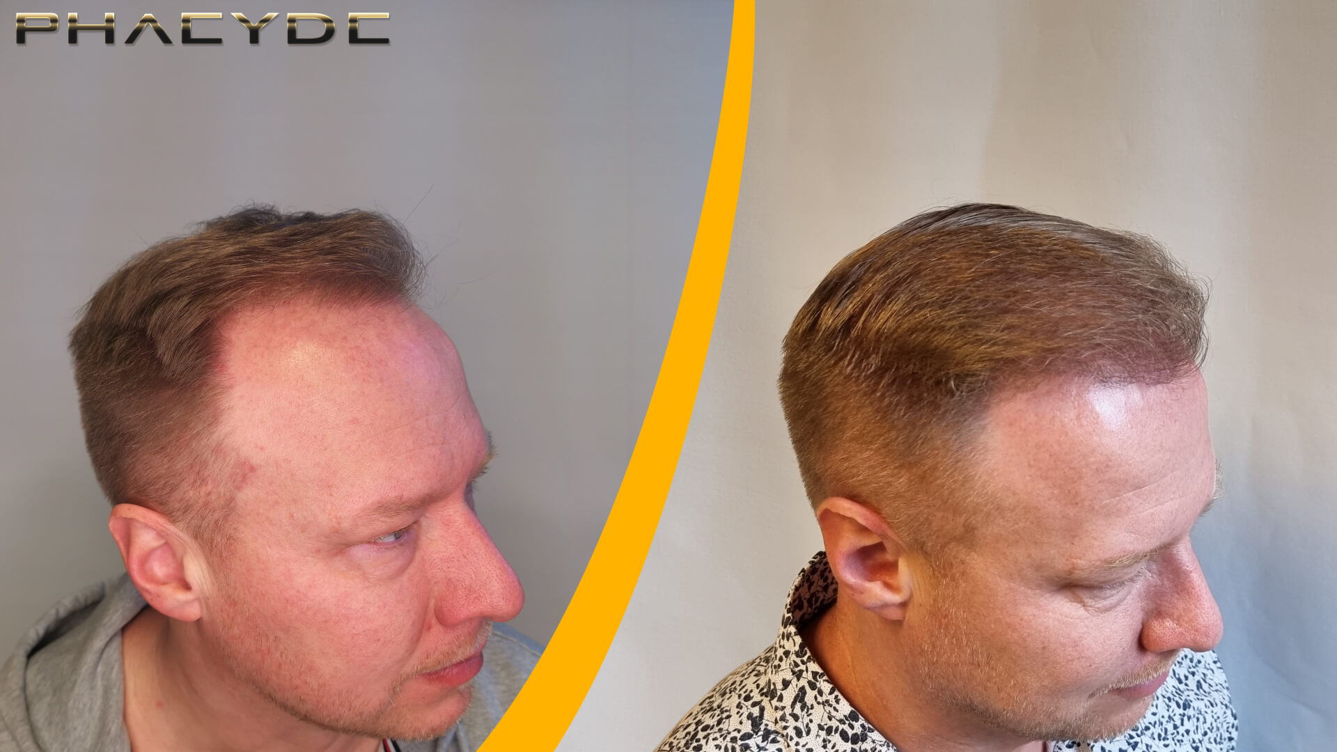 Före & Efter Hårtransplantation – 1600 Grafts