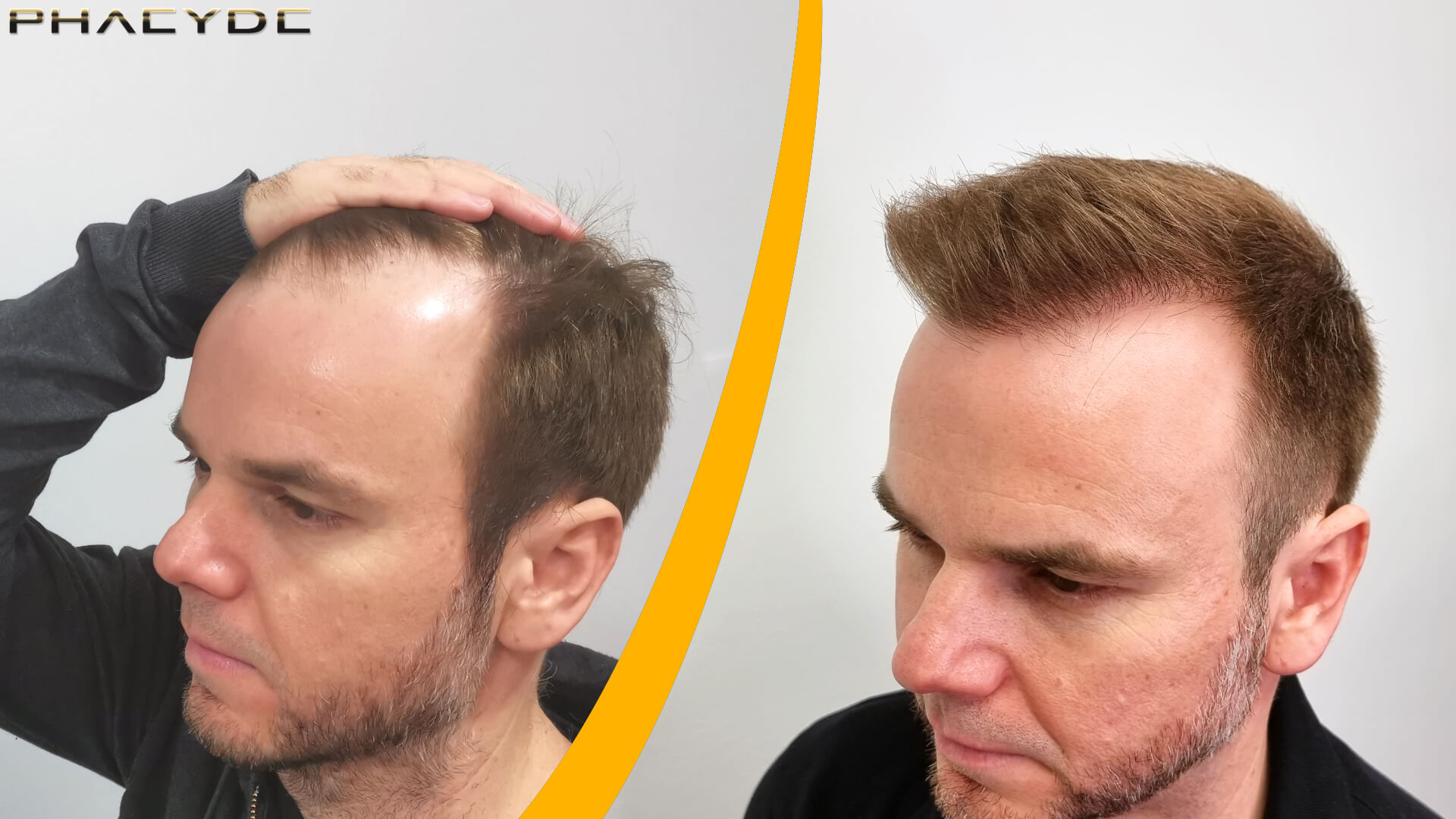 Håransplantat - Före & Efter-resultat