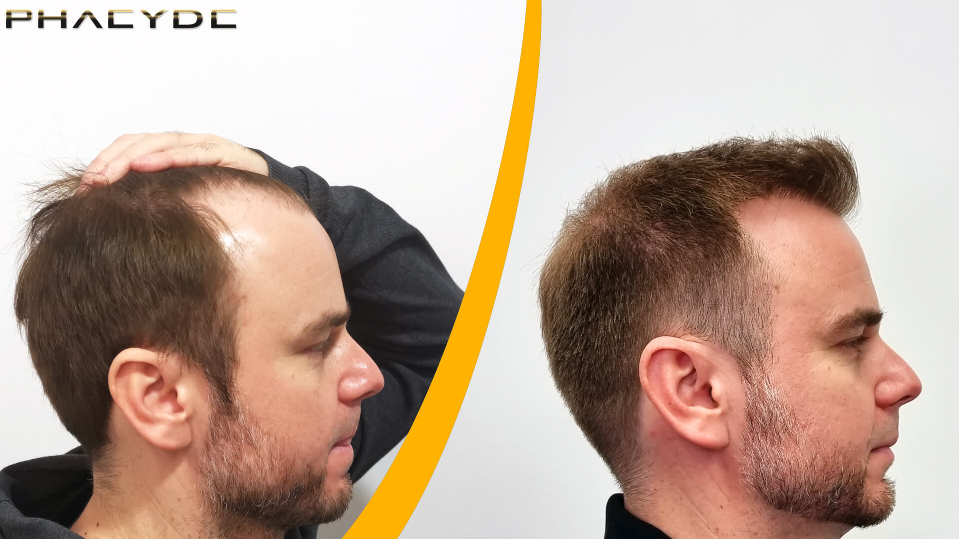 Innan och efter en hårtransplantation