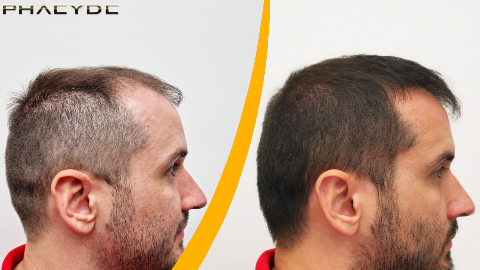 Innan och efter en hårtransplantation