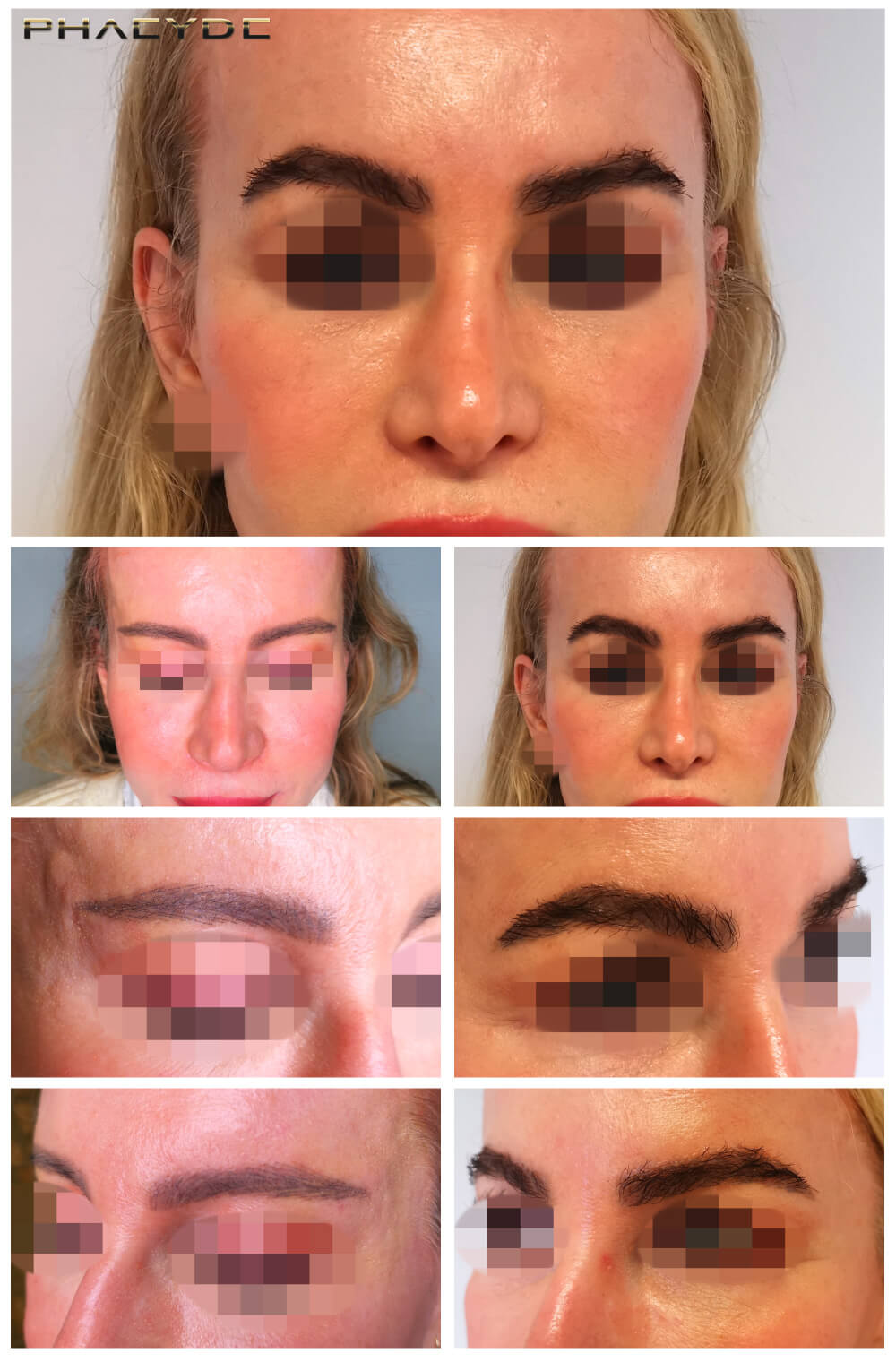 Ögonbryntransplantation