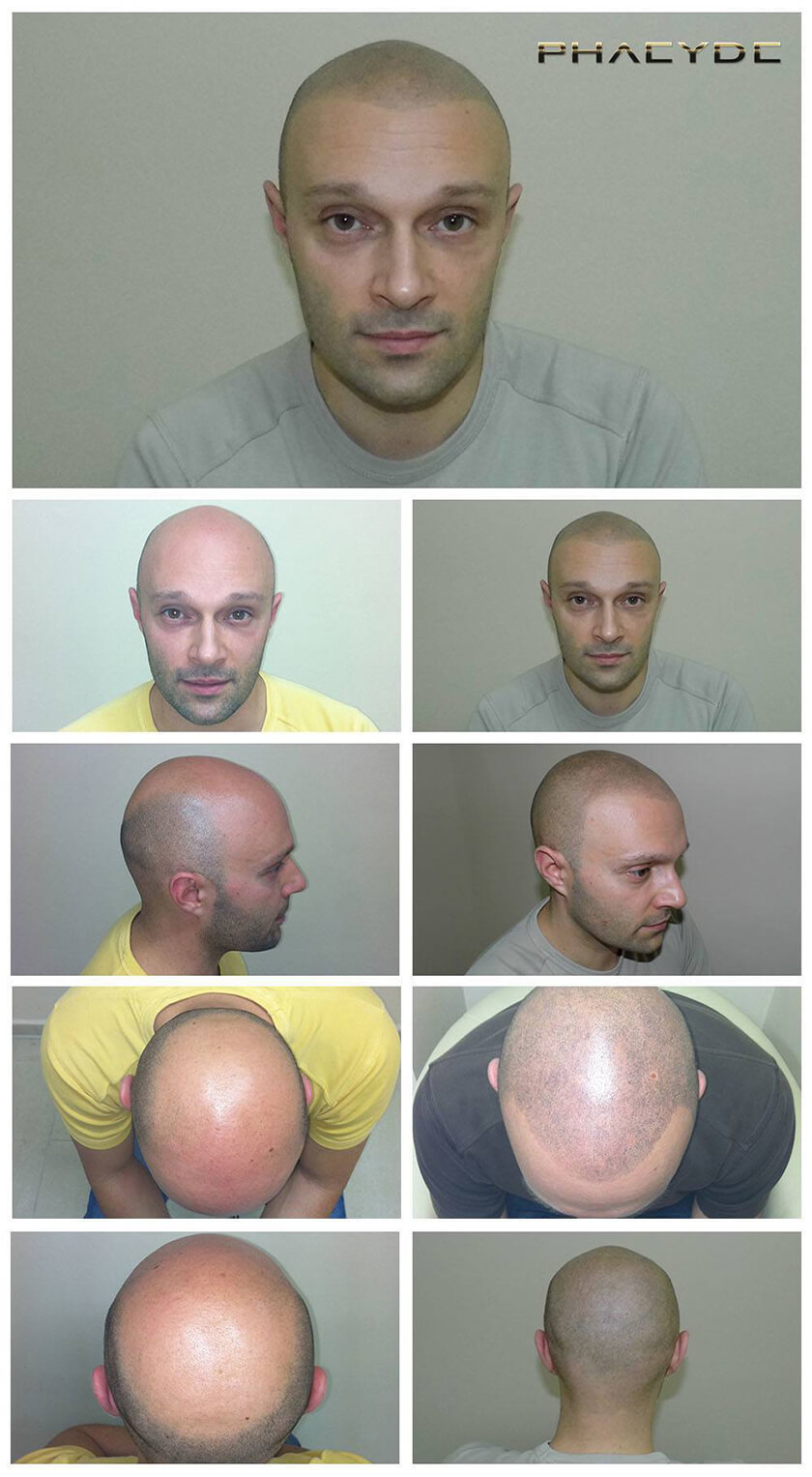 Before After Hair Pigmentation Photos at PHAEYDE Clinic