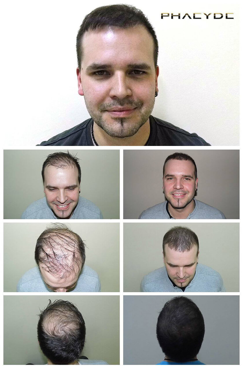 Before After Hair Pigmentation Photos at PHAEYDE Clinic