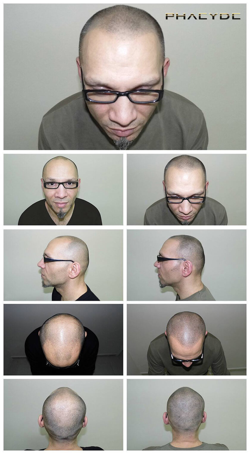Before After Hair Pigmentation Photos at PHAEYDE Clinic