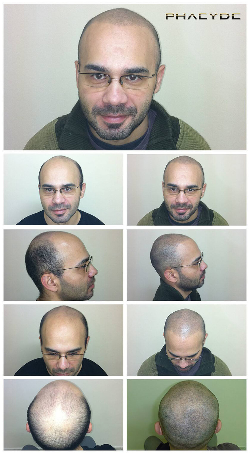 Before After Hair Pigmentation Photos at PHAEYDE Clinic