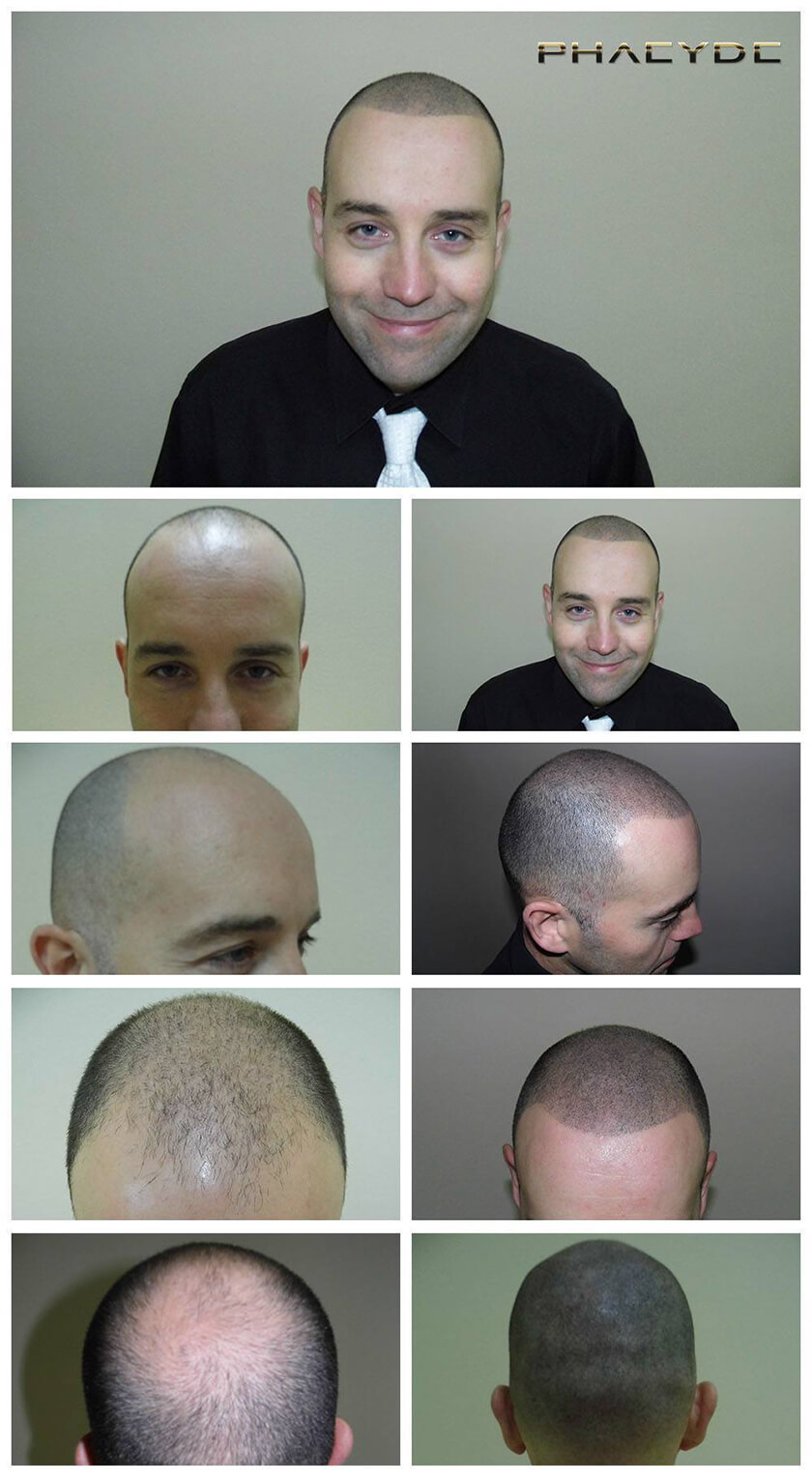 Before After Hair Pigmentation Photos at PHAEYDE Clinic