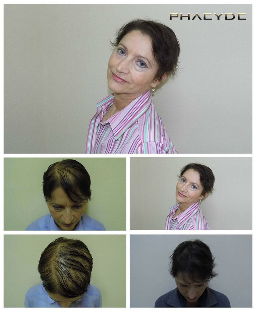 Before After Hair Pigmentation Photos at PHAEYDE Clinic